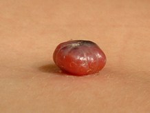keratoacanthoma